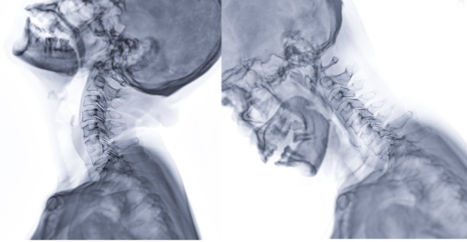 Side-by-side lateral cervical spine radiographs in extension and flexion, the stress views that reveal ligament laxity after whiplash — the imaging decisions at the center of Physical Examination 213: The Whiplash Patient, a two-hour chiropractic CE course from CCEDseminars
