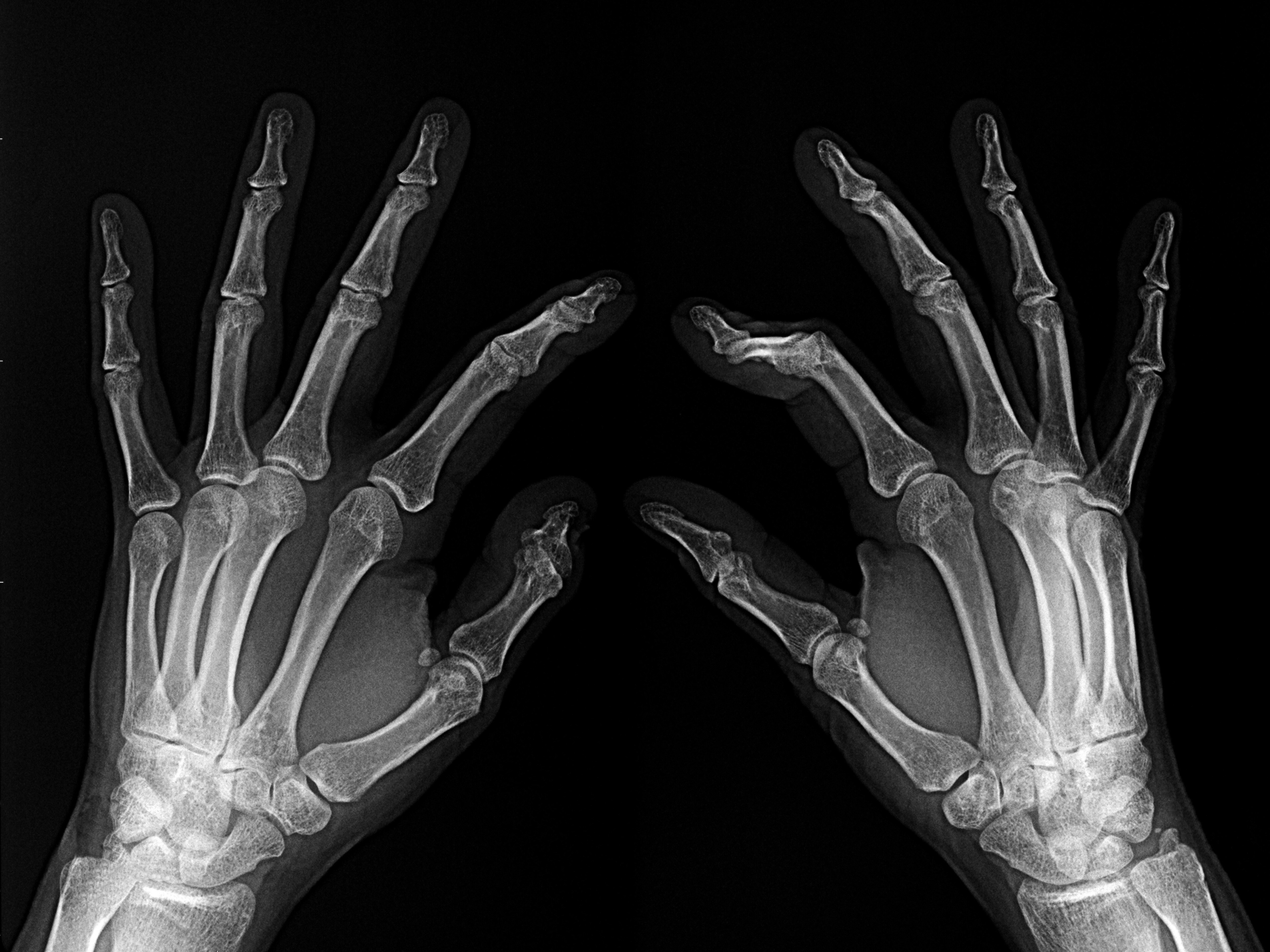 xray image of arthritic hands on on our chiropractic ce courses page