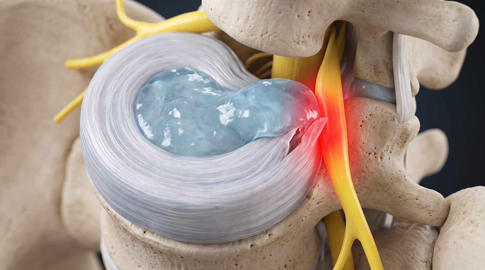 Three-dimensional medical illustration of a lumbar intervertebral disc herniation, the nucleus pulposus breaching the annulus fibrosus and compressing an inflamed spinal nerve root shown in red — Case Studies & Clinical Pearls 216: Disc Herniation.