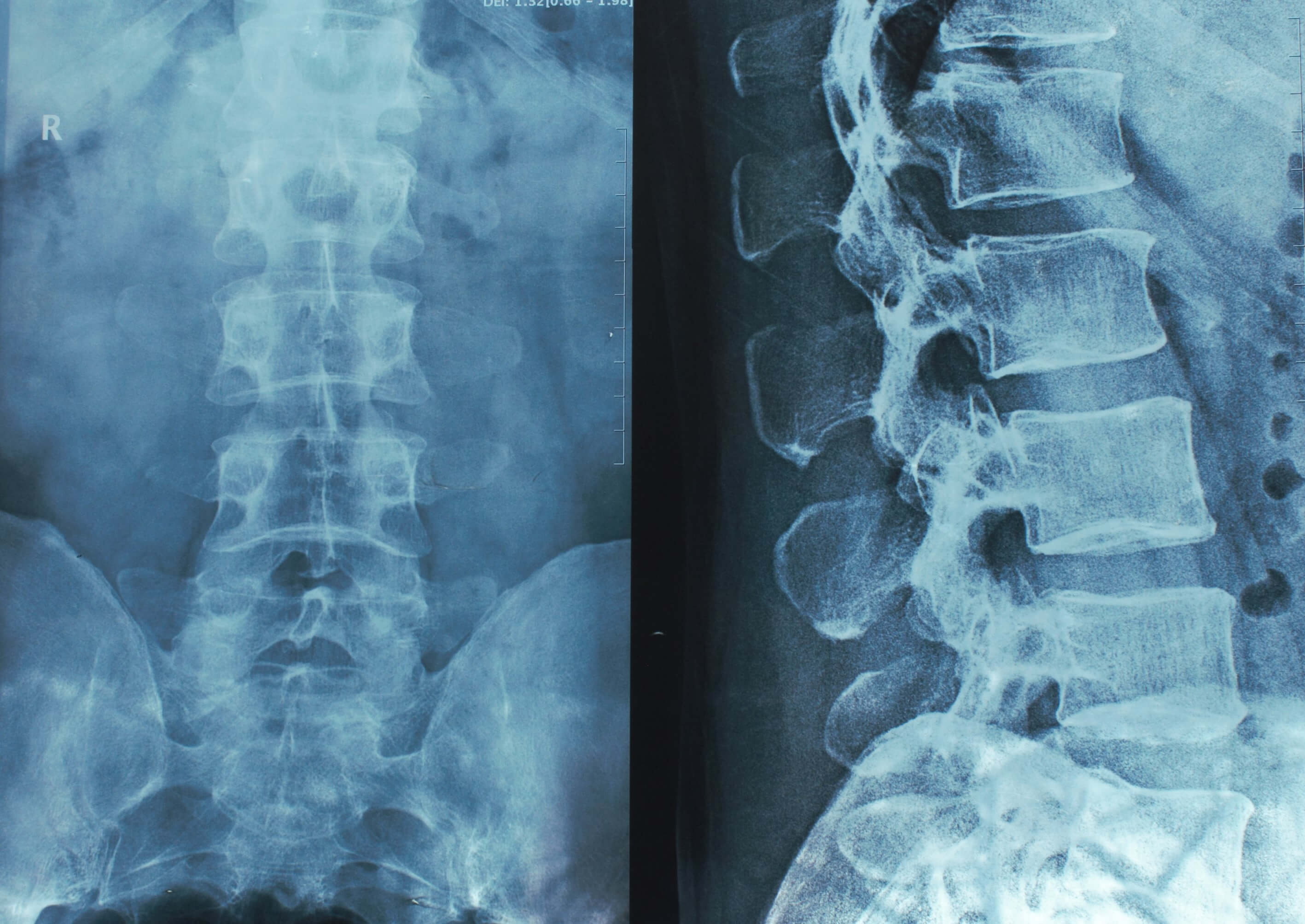 image of lumbar spine on our online chiropractic education page