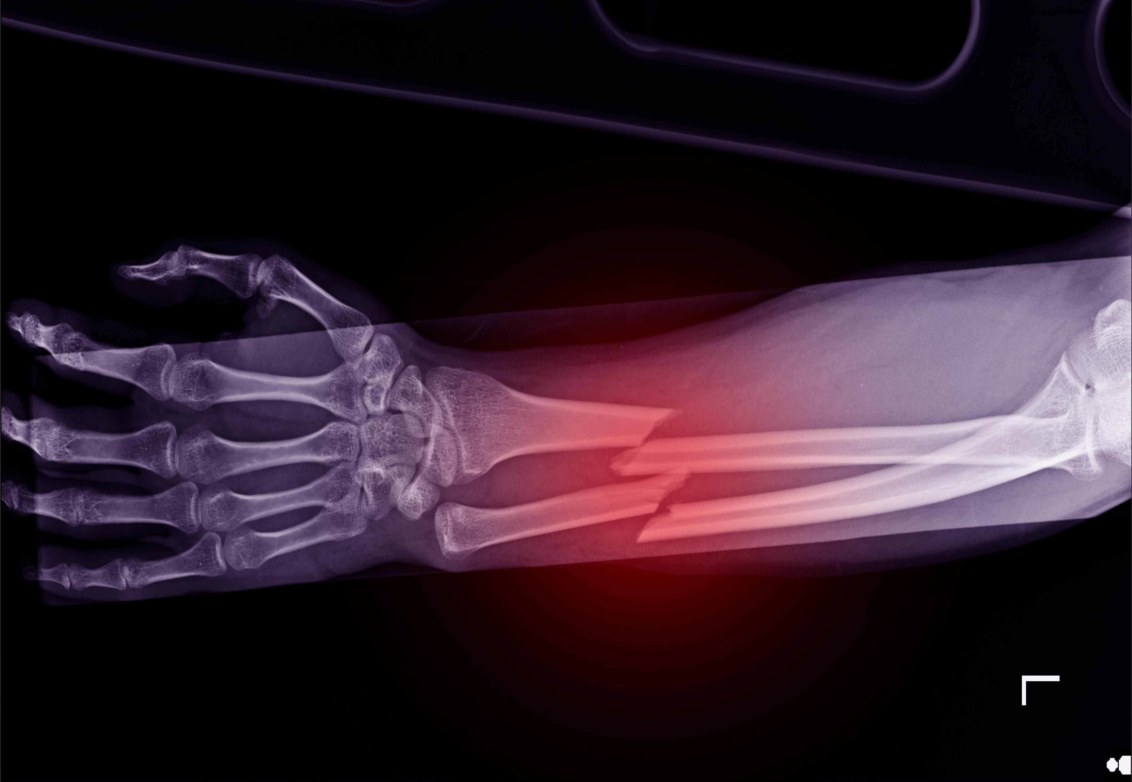 image of arm injuries on our chiropractic continuing education online page