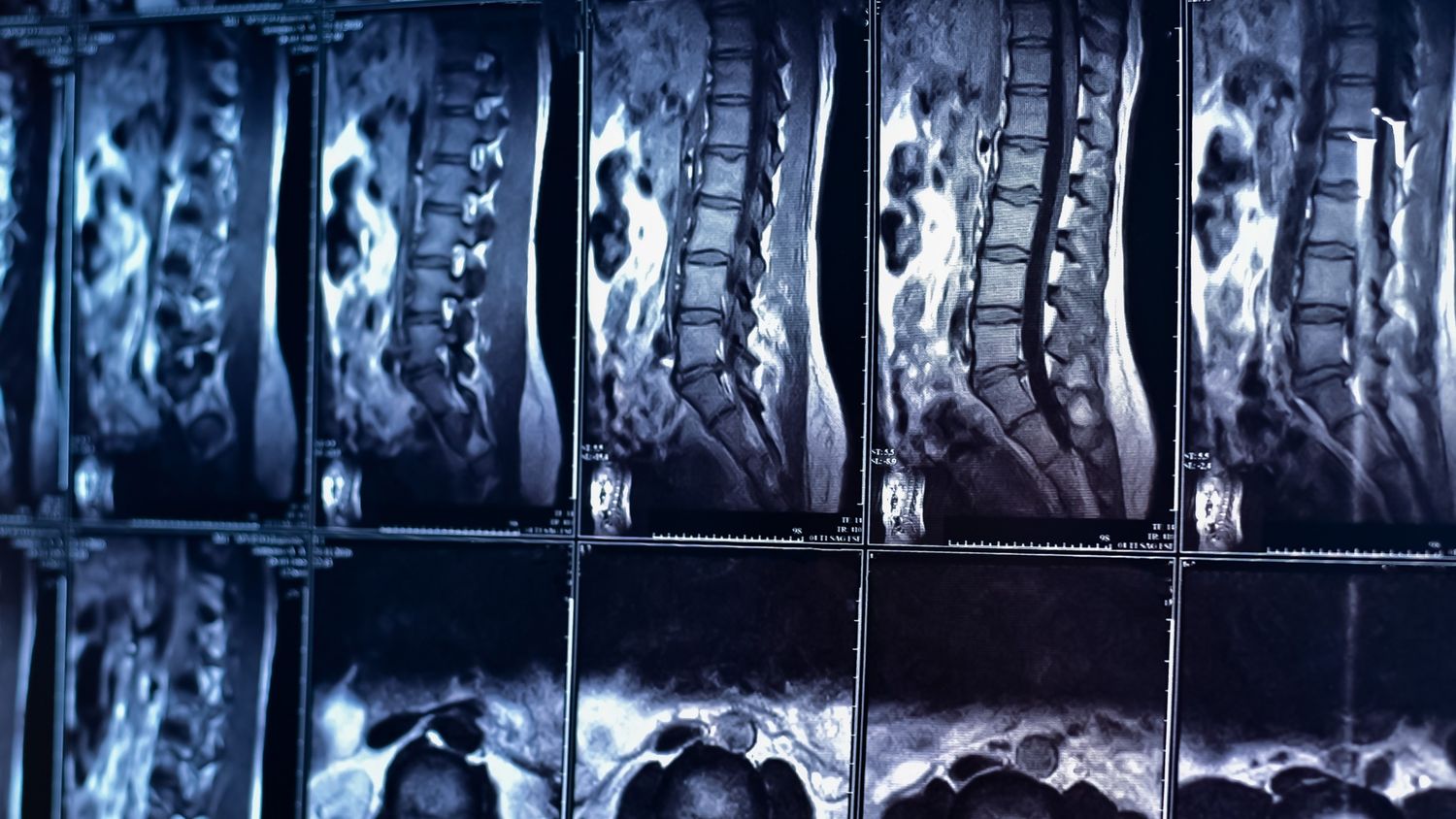 Lumbar spine MRI showing vertebral alignment and disc integrity — used in chiropractic continuing education courses on spinal examination and diagnosis.