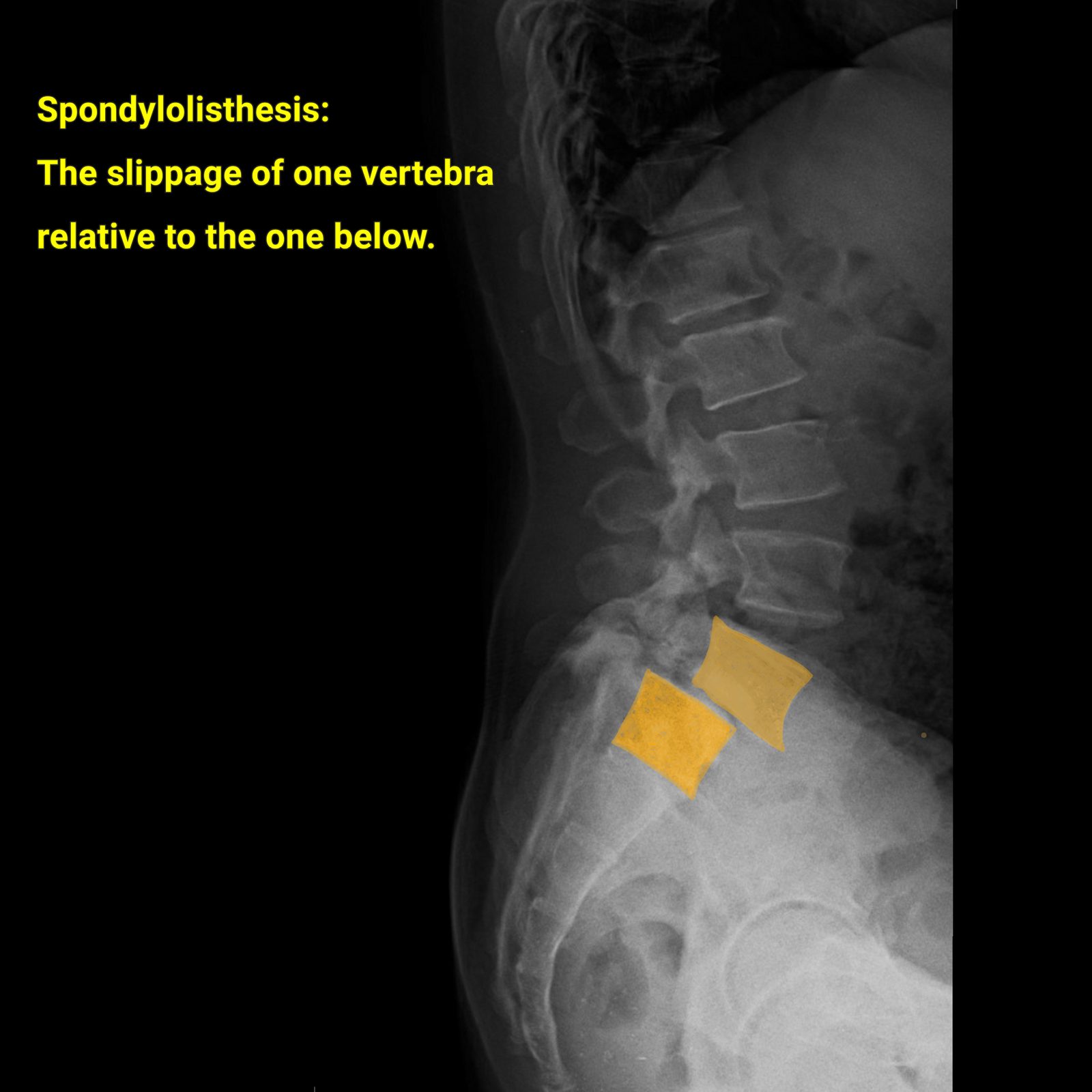 Annotated lateral lumbar spine radiograph demonstrating spondylolisthesis, with the L5 and S1 vertebral bodies highlighted in gold to mark the forward slippage of one vertebra on the one below — Case Studies & Clinical Pearls 217: Spondylolisthesis Treatment.