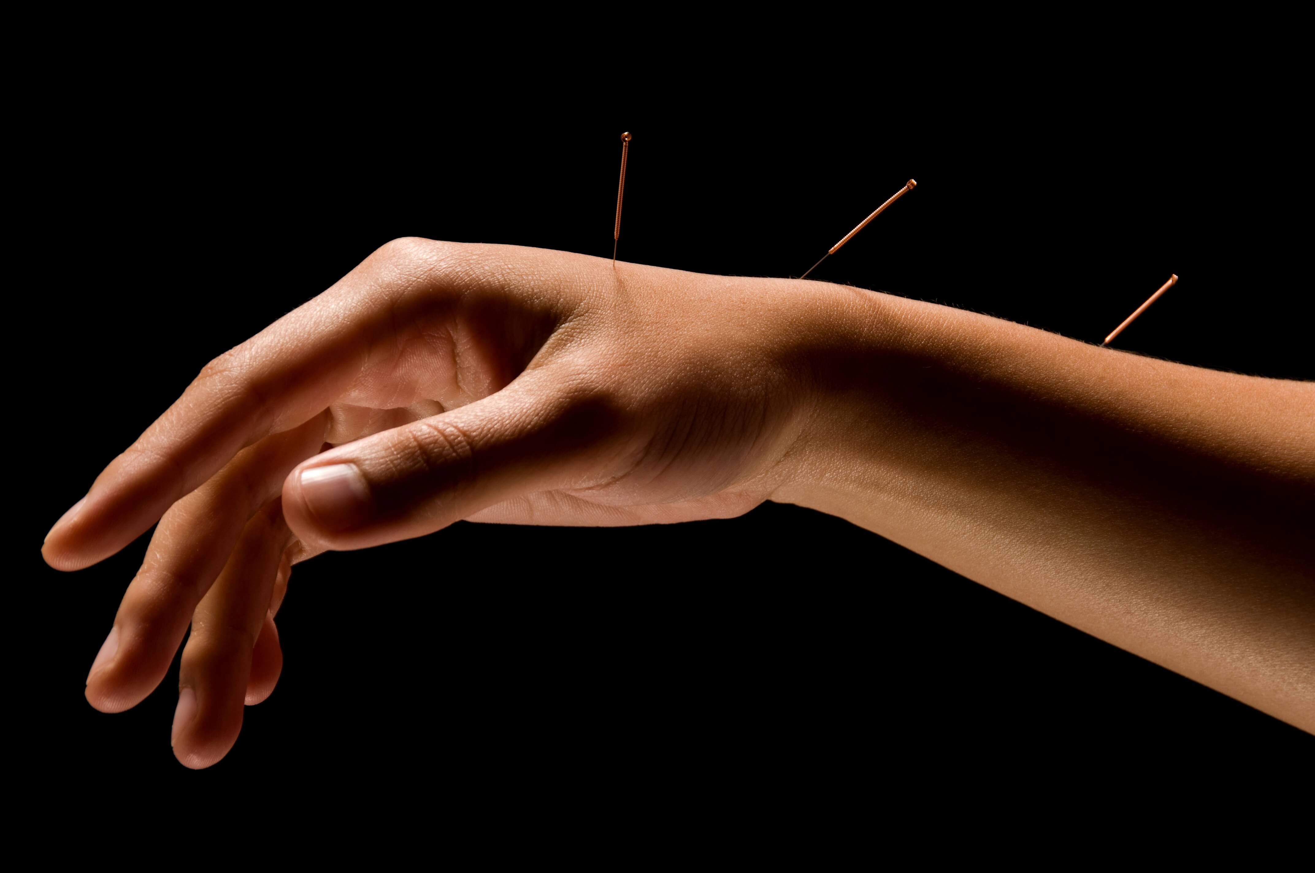 imagte of acupuncture on our chiropractic ceu online page