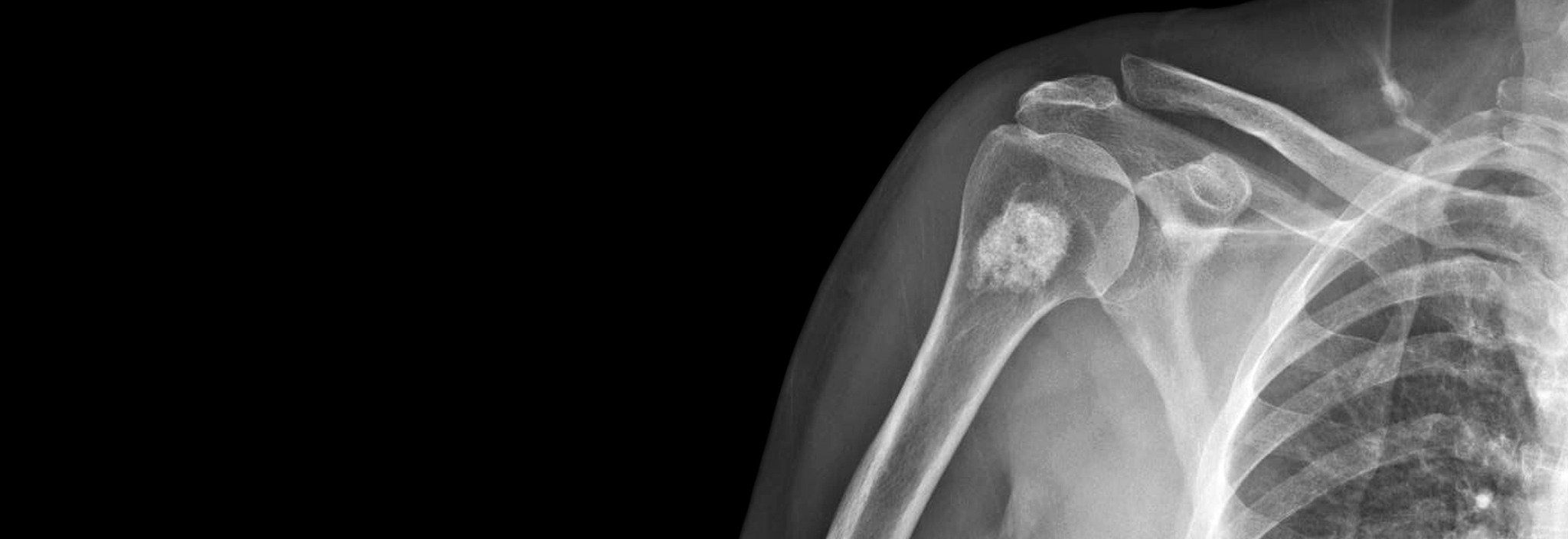 X-ray of shoulder used in chiropractic CE course on shoulder examination
