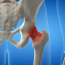 Geriatrics 203: Lower Extremities Osteoarthritis image