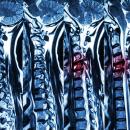 Orthopedics 222: Dropped Head Syndrome, Cervical Myelopathy, and ALS image
