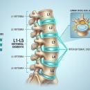High-resolution anatomical model of the lumbar spine highlighting the L1-L5 vertebrae and intervertebral discs for clinical reasoning and evidence-based management analysis.
