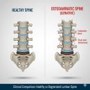 Anatomical illustration of spinal osteoarthritis comparing healthy vertebrae to degenerated segments with facet joint hypertrophy and osteophyte formation for clinical chiropractic analysis.
