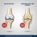 High-resolution anatomical comparison of a healthy knee joint vs. a knee joint with osteoarthritis, highlighting joint space narrowing and bone spurs for geriatric chiropractic analysis.