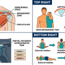 Clinical rotator cuff diagram — supraspinatus/infraspinatus/teres minor/subscapularis anatomy, subacromial impingement, Neer and Hawkins-Kennedy tests, MRI cross-section — Orthopedics 204 chiropractic CE course.