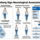 Romberg test positions eyes open/closed, vestibular/proprioceptive/visual pathways, modified variants (foam pad, tandem), research evidence table — Orthopedics 209 CE