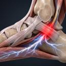 Anatomical illustration of the foot and ankle with an inflamed nerve glowing red at the tarsal tunnel and blue electrical branches along the sole — Orthopedics 203, nerve entrapments of the pelvis and lower extremities