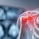 Orthopedics 204: Rotator Cuff Syndrome | Chiropractic CE image