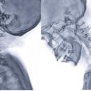 Side-by-side lateral cervical spine radiographs in extension and flexion, the stress views that reveal ligament laxity after whiplash — the imaging decisions at the center of Physical Examination 213: The Whiplash Patient, a two-hour chiropractic CE course from CCEDseminars