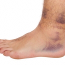 Sports Injuries 264: Conditions of the Foot and Ankle image