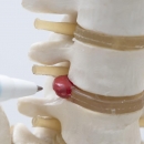 Case Studies & Clinical Pearls 216: Disc Herniation | Chiropractic CE Credits image